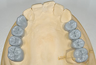 STEP3　歯型の作製