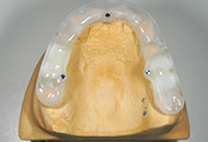 STEP4　歯型のCT撮影