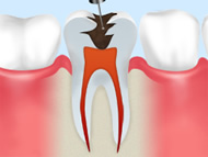 歯を削って根管を露出する