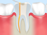 歯の根を広げ清掃と消毒